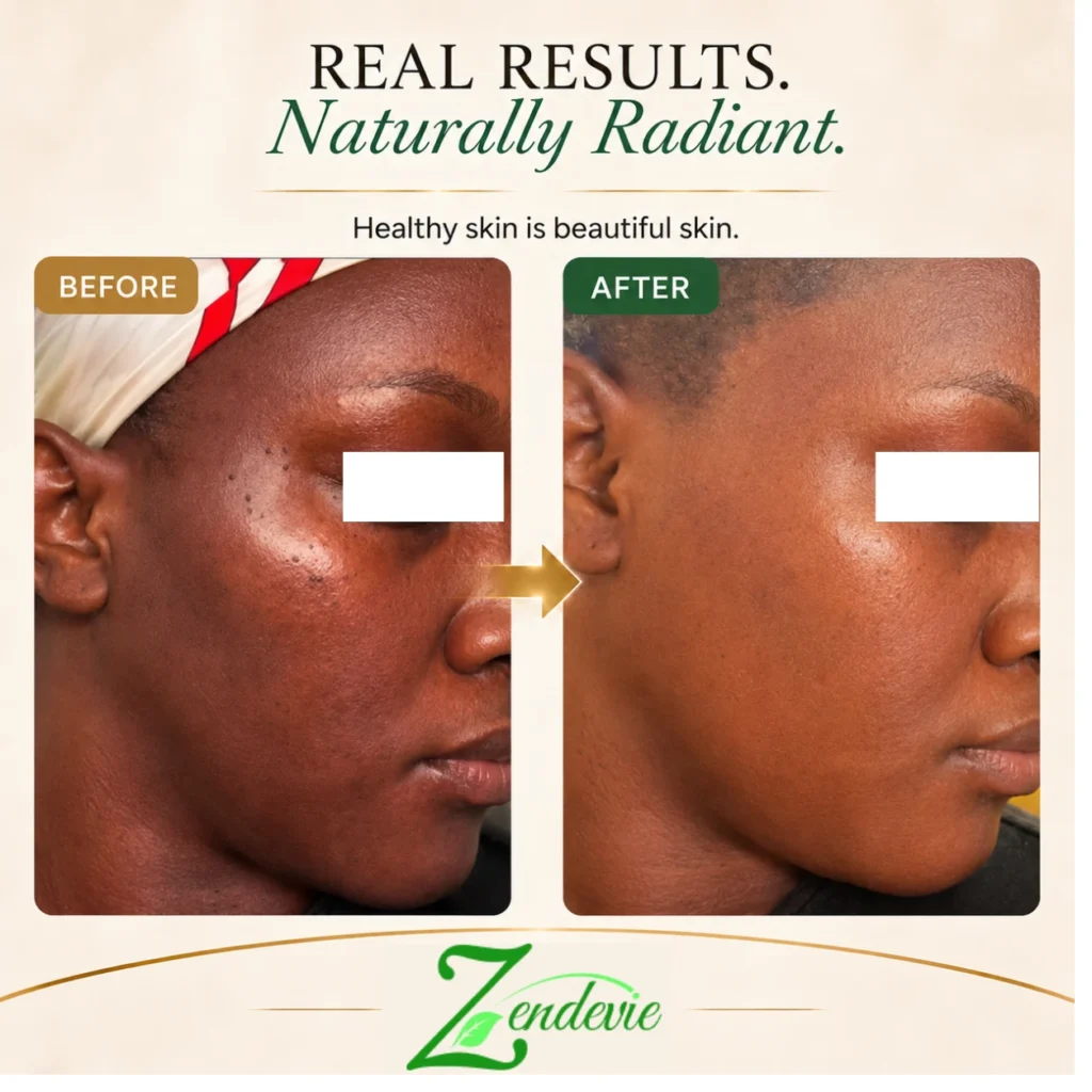 Zendevie before-and-after skincare result showing blemish-prone skin with a smoother-looking, more even-looking radiant complexion.