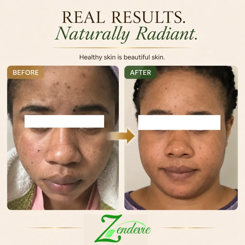 Zendevie before-and-after skincare result showing blemish-prone skin with a calmer, smoother-looking, more even-looking complexion.