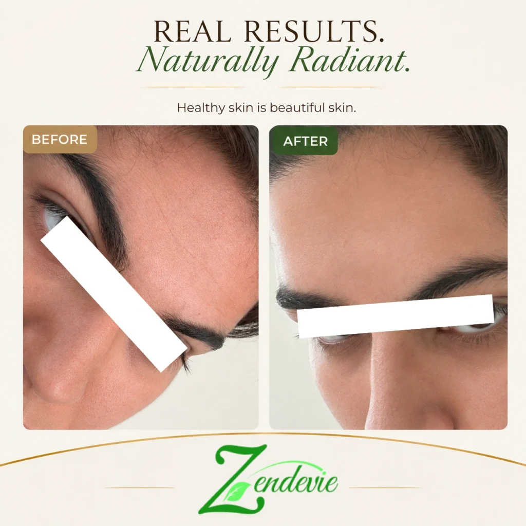 Zendevie before-and-after skincare result showing smoother-looking skin around the forehead and eye area.